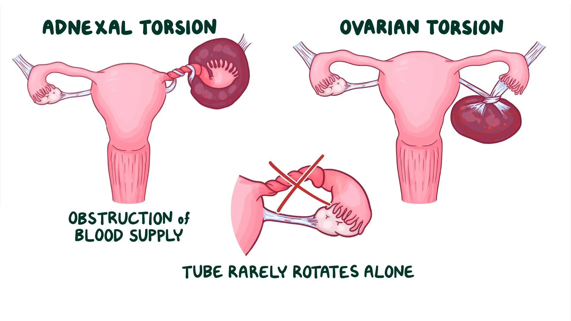 THE ULTIMATE GUIDE TO MANAGING ADNEXAL TORSION: FROM SYMPTOMS TO SURGICAL SOLUTIONS
