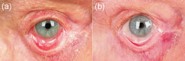 PATHOPHYSIOLOGY, DIAGNOSIS, AND MANAGEMENT OF OCULAR MUCOUS MEMBRANE PEMPHIGOID: AN IN-DEPTH GUIDE