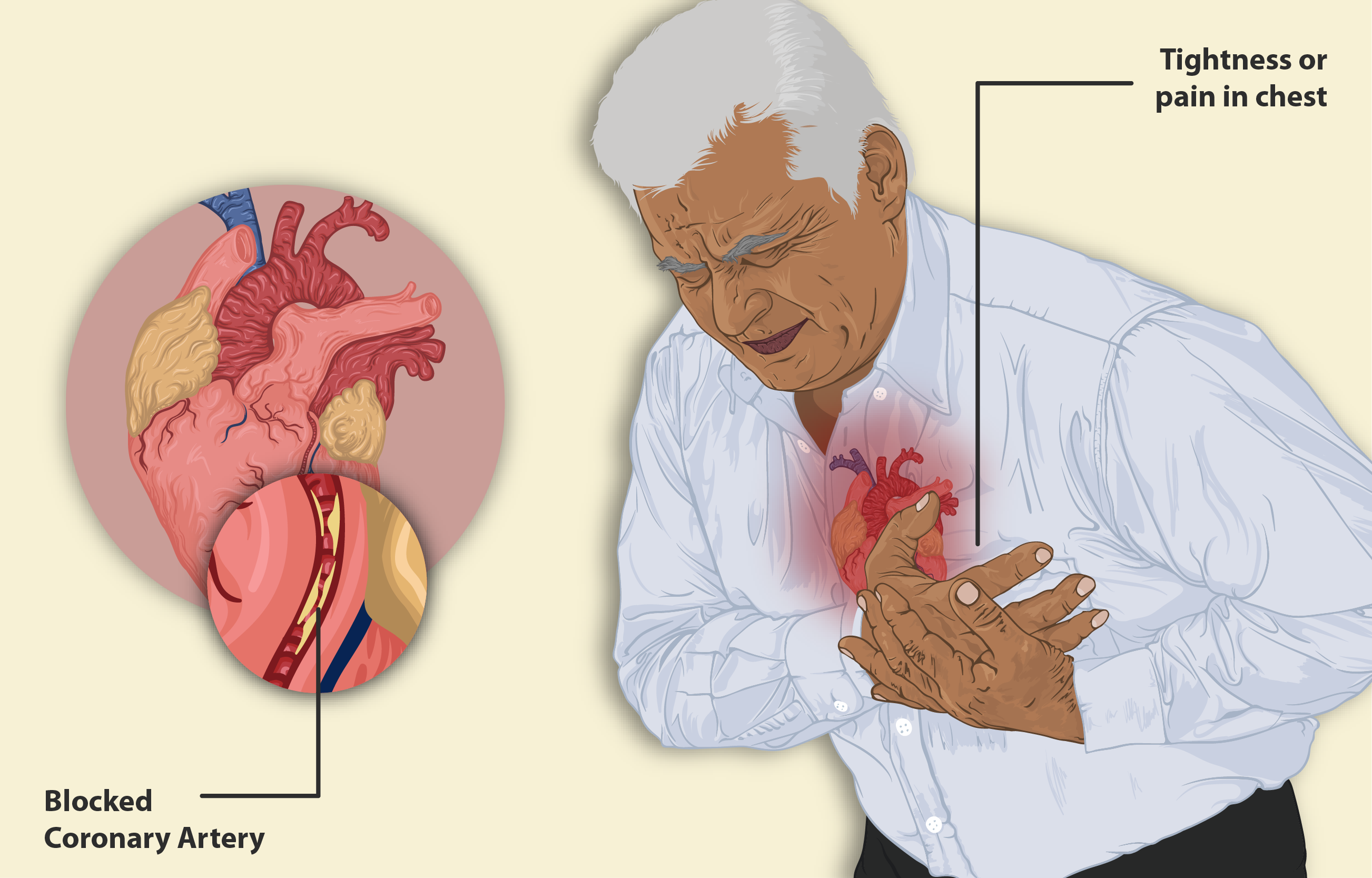 HOW TO RECOGNIZE ANGINA PECTORIS: A GUIDE FOR EARLY DETECTION