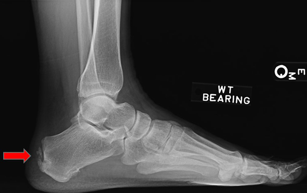 UNDERSTANDING AND TREATING ACHILLES TENDON ENTHESOPATHY