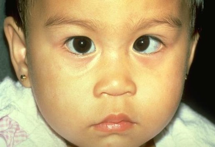 NAVIGATING AMBLYOPIA WITH PARENTS AND VISION-CARE EXPERTS