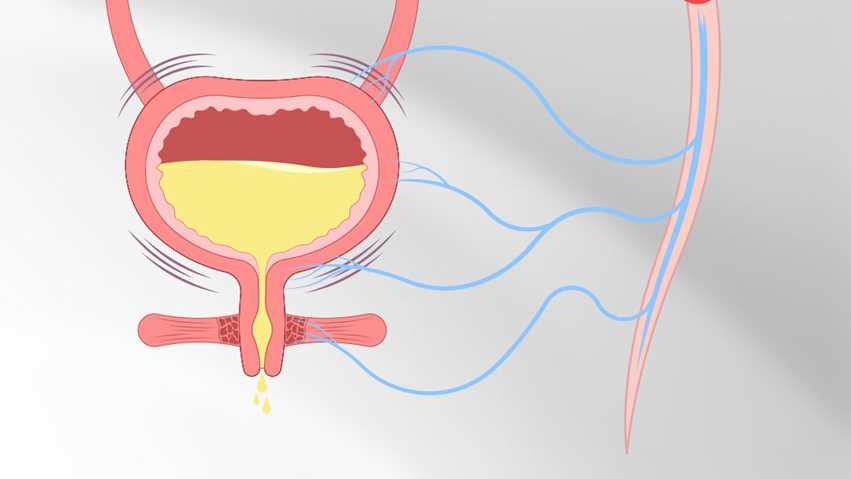 UNDERSTANDING NEUROGENIC BLADDER: SYMPTOMS, DIAGNOSIS, AND MANAGEMENT EXPLAINED