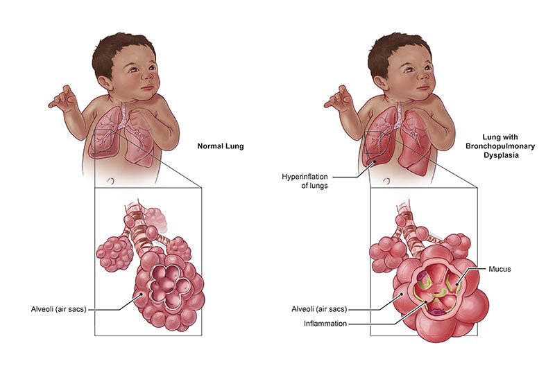 BRONCHOPULMONARY DYSPLASIA: SYMPTOMS, CAUSES, AND TREATMENTS EXPLAINED