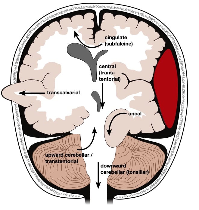 CLINICAL INSIGHTS INTO BRAIN HERNIATION: AN IN-DEPTH ANALYSIS