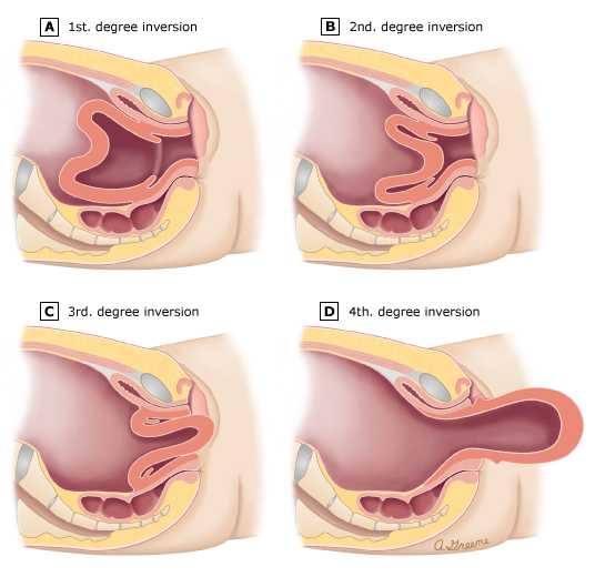IMMEDIATE RESPONSE TO UTERINE INVERSION: ESSENTIAL EMERGENCY PROCEDURES