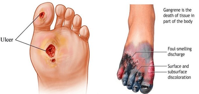 LEG ULCERATION CARE: BEST PRACTICES FOR RECOVERY