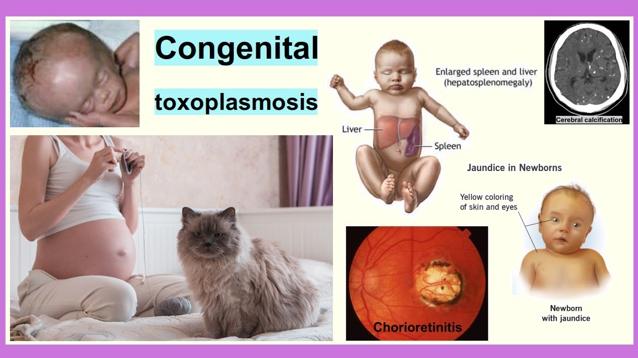 CONGENITAL TOXOPLASMOSIS: IN-DEPTH CLINICAL ANALYSIS AND TREATMENT STRATEGIES