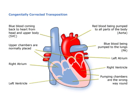AN INTRODUCTION TO CONGENITALLY CORRECTED TRANSPOSITION OF THE GREAT ARTERIES: SYMPTOMS, DIAGNOSIS, AND TREATMENT