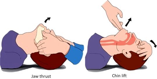 AIRWAY MANAGEMENT IN EMERGENCY CARE: A COMPREHENSIVE GUIDE TO THE HEAD TILT-CHIN LIFT AND JAW-THRUST MANEUVERS