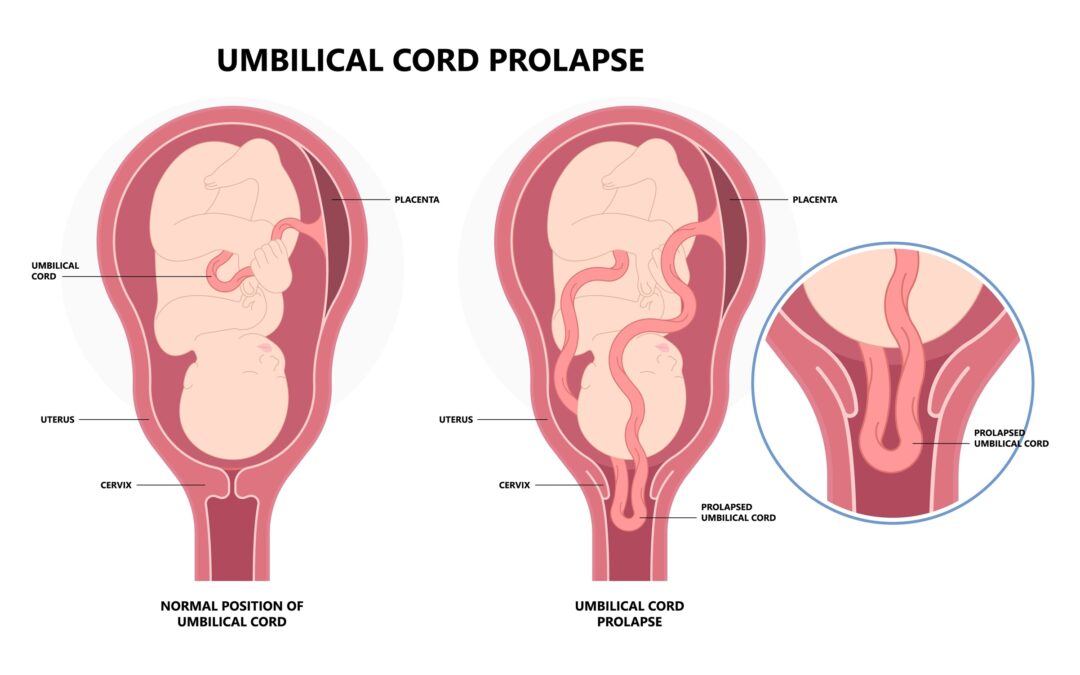 UMBILICAL CORD PROLAPSE: AN IN-DEPTH OBSTETRIC ANALYSIS