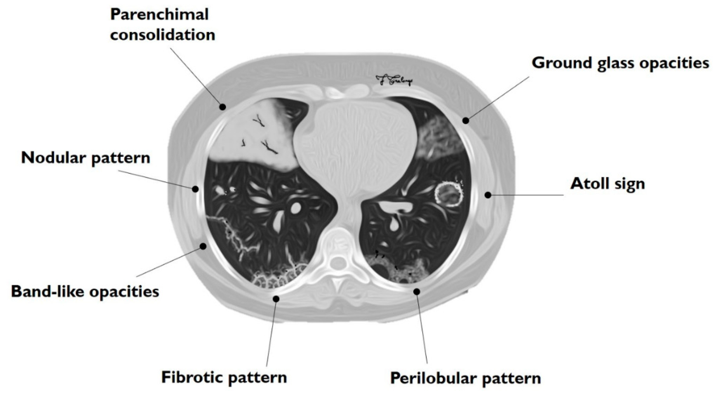 UNDERSTANDING CRYPTOGENIC ORGANIZING PNEUMONIA: THE ESSENTIALS OF DIAGNOSIS AND MANAGEMENT