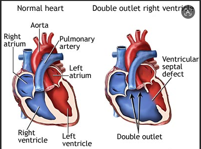 DOUBLE OUTLET RIGHT VENTRICLE: CLINICAL OVERVIEW AND ESSENTIAL INSIGHTS
