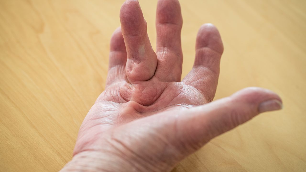 YOUR ESSENTIAL GUIDE TO DUPUYTREN’S CONTRACTURE: FROM DIAGNOSIS TO TREATMENT OPTIONS
