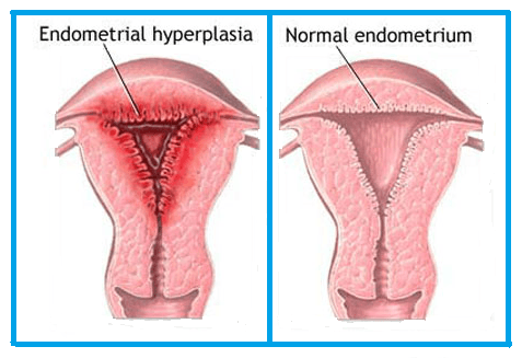 ENDOMETRIAL HYPERPLASIA AND CANCER: A COMPREHENSIVE GUIDE TO THE DISEASE SPECTRUM