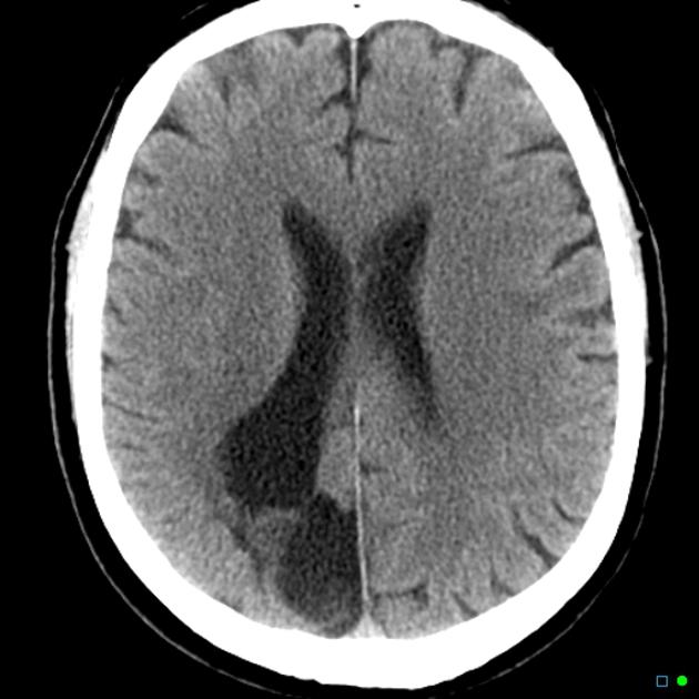 INTRODUCTION TO PORENCEPHALY: EVERYTHING YOU NEED TO KNOW