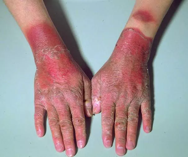 ALL YOU NEED TO KNOW ABOUT HARTNUP DISEASE