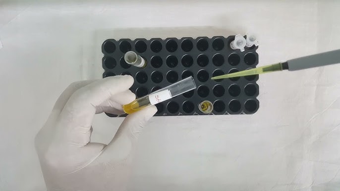 ENHANCING LAB ACCURACY: INNOVATIVE TECHNIQUES IN SERUM ALBUMIN ESTIMATION