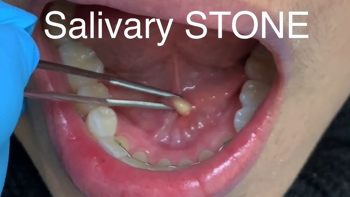 SIALOLITHIASIS AND SIALECTASIS: UNDERSTANDING SALIVARY GLAND STONES AND DUCT DILATION
