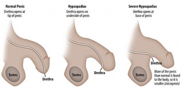 INNOVATIVE APPROACHES IN THE MANAGEMENT OF HYPOSPADIAS