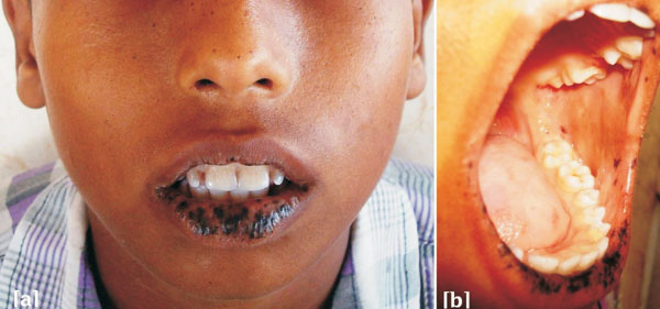 A DEEP DIVE INTO PEUTZ-JEGHERS SYNDROME: ESSENTIAL INFORMATION FOR CLINICIANS