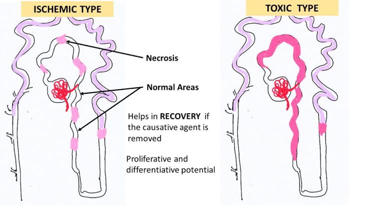 MORPHOLOGY AND DAMAGE PATTERNS IN ACUTE TUBULAR INJURY: KEY ETIOLOGICAL FACTORS