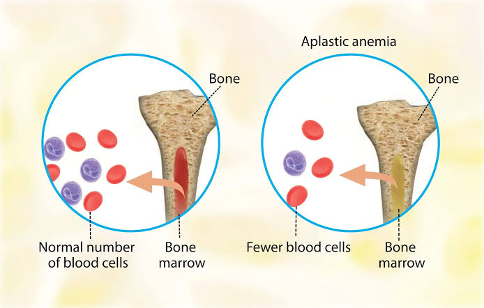 INTRODUCTION TO ANEMIAS: CLASSIFICATION AND STRATEGIES FOR DIAGNOSIS