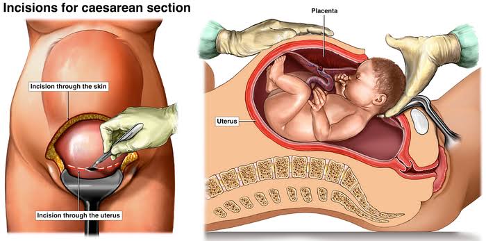 PREPARING FOR A CESAREAN SECTION: ESSENTIAL INFO FOR MOMS
