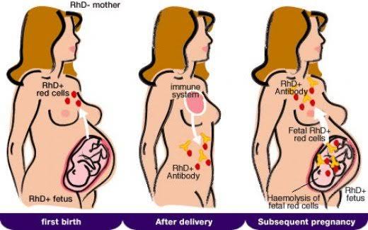 RH ISO-IMMUNIZATION DURING PREGNANCY