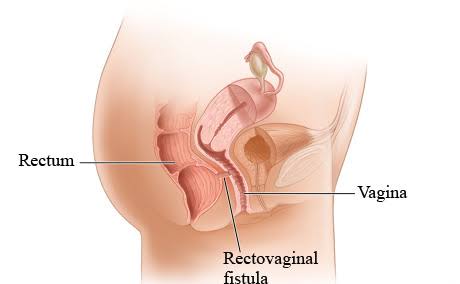 OLD COMPLETE PERINEAL TEAR AND RECTOVAGINAL FISTULAS
