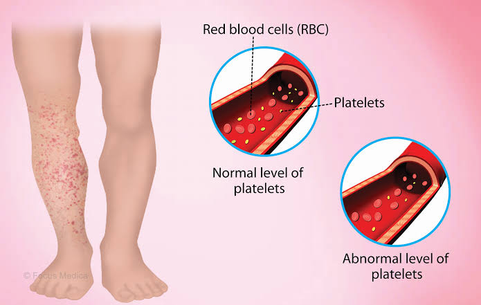 INHERITED DISORDERS OF PLATELETS FUNCTION, IDIOPATHIC THROMBOCYTOPENIC PURPURA AND THROMBOTIC THROMBOCYTOPENIC PURPURA