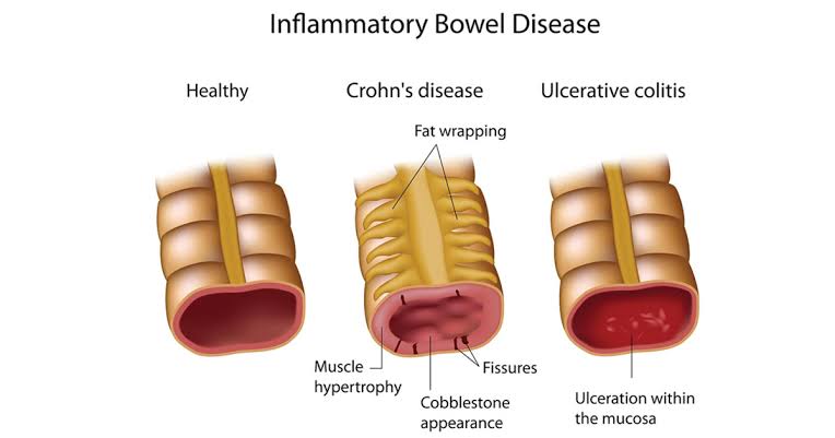 COLORECTAL DISEASES: SYMPTOMS, DIAGNOSIS AND TREATMENT OPTIONS