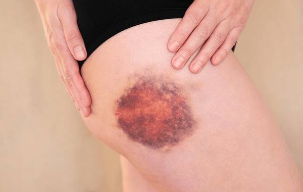 BLEEDING DIATHESIS PLATELET DISORDERS