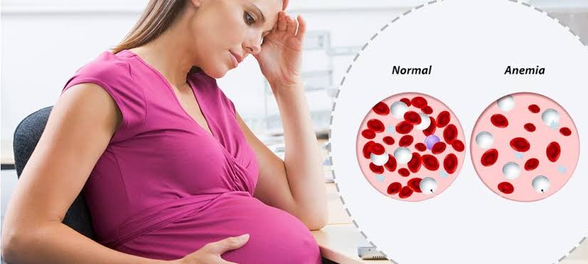 UNDERSTANDING ANEMIA DURING PREGNANCY: KEY FACTS