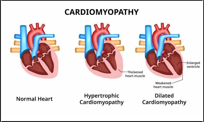 CARDIOMYOPATHY: WHAT YOU SHOULD KNOW ABOUT HEART MUSCLE DISEASE