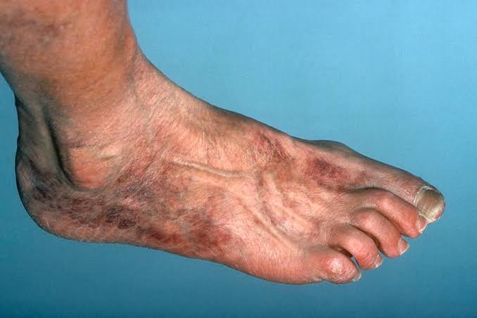 RISKS AND COMPLICATIONS OF ACUTE ARTERIAL OCCLUSION