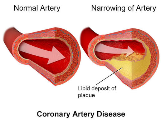 TOP STRATEGIES FOR MANAGING CORONARY ATHEROSCLEROSIS EFFECTIVELY