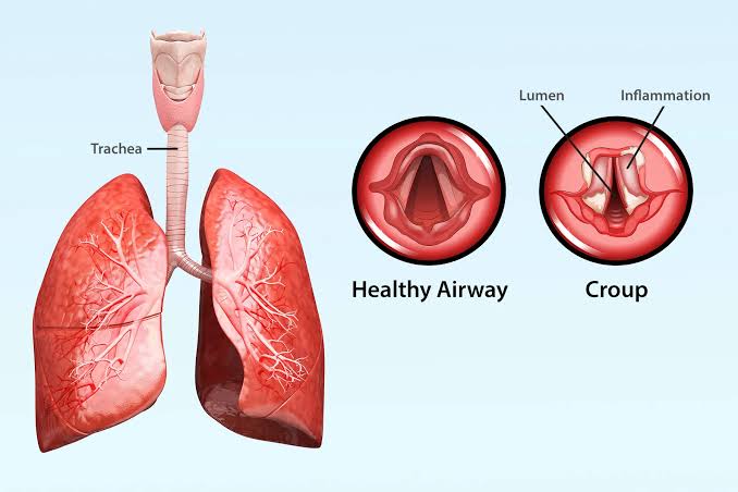 EFFECTIVE MANAGEMENT OF CROUP: A COMPLETE APPROACH FOR CLINICIANS