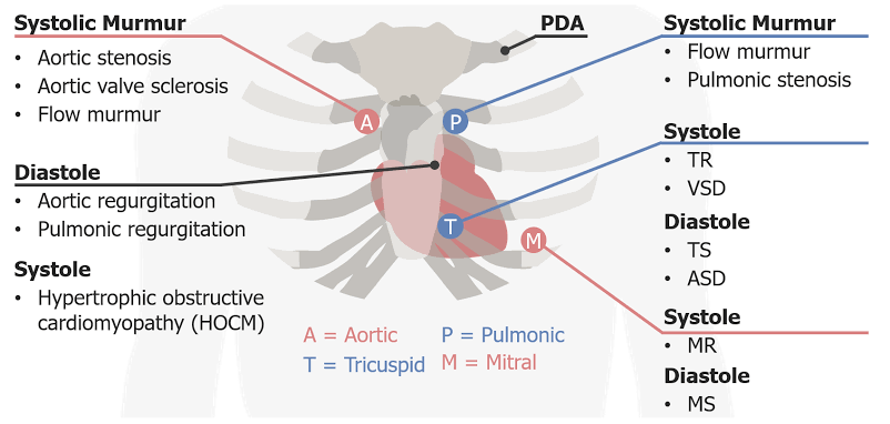 LEARN ABOUT HEART SOUNDS: A SIMPLE BREAKDOWN