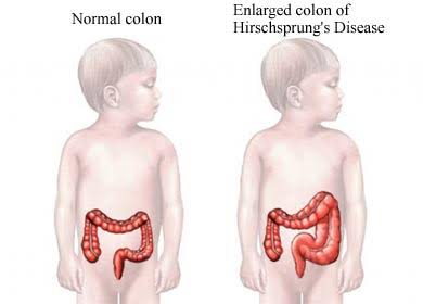 HOW DOCTORS DIAGNOSE HIRSCHSPRUNG’S DISEASE IN CHILDREN