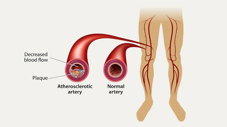 MANAGING CHRONIC OCCLUSIVE ARTERIAL DISEASE