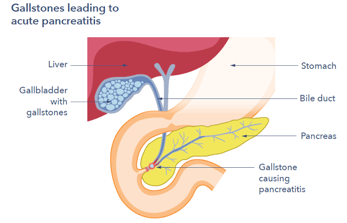 ACUTE PANCREATITIS: SIMPLE EXPLANATIONS AND KEY FACTS