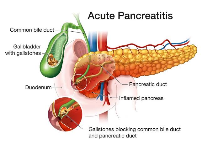 COMMON DISEASES OF THE EXOCRINE PANCREAS