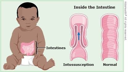 THE SCIENCE BEHIND INTUSSUSCEPTION: AN IN-DEPTH LOOK AT ITS PATHOGENESIS