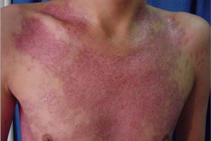 NAVIGATING LANGERHANS CELL HISTIOCYTOSIS: WHAT YOU NEED TO KNOW