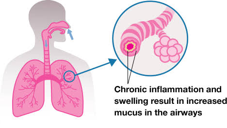 HOW OBSTRUCTIVE LUNG DISEASE AFFECTS BREATHING AND HEALTH