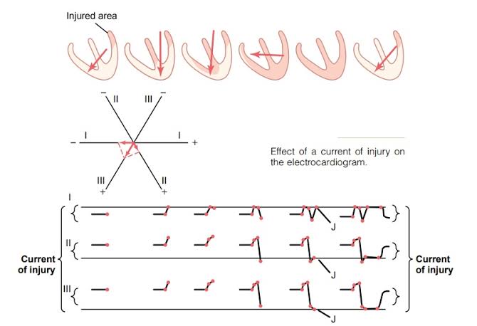 THE ROLE OF INJURY CURRENT IN MODIFYING THE ST SEGMENT