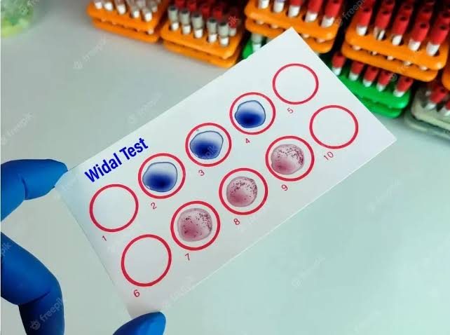 DIAGNOSTIC TEST FOR TYPHOID FEVER BY WIDAL TEST
