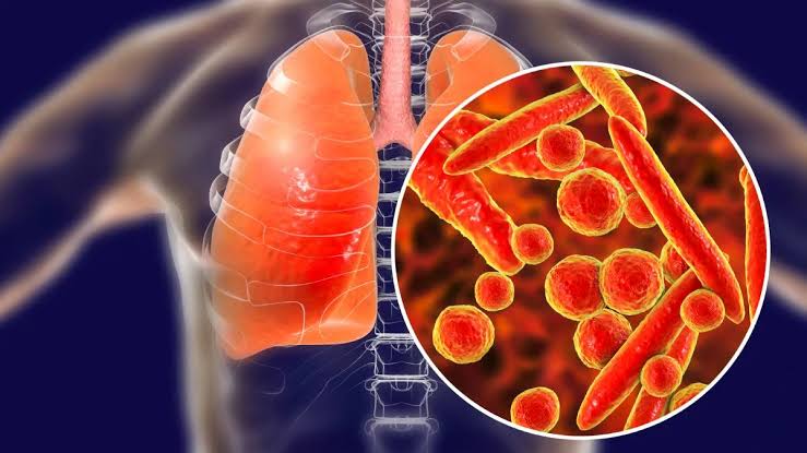LOWER RESPIRATORY TRACT INFECTIONS: MYCOPLASMA AND LEGIONELLA