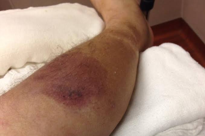 TREATING NECROTIZING SOFT TISSUE INFECTIONS EFFECTIVELY