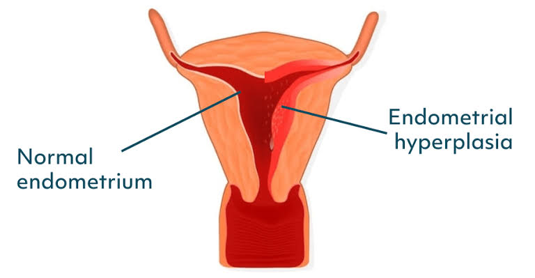 PATHOPHYSIOLOGY OF ENDOMETRIAL HYPERPLASIA AND DYSFUNCTIONAL UTERINE BLEEDING